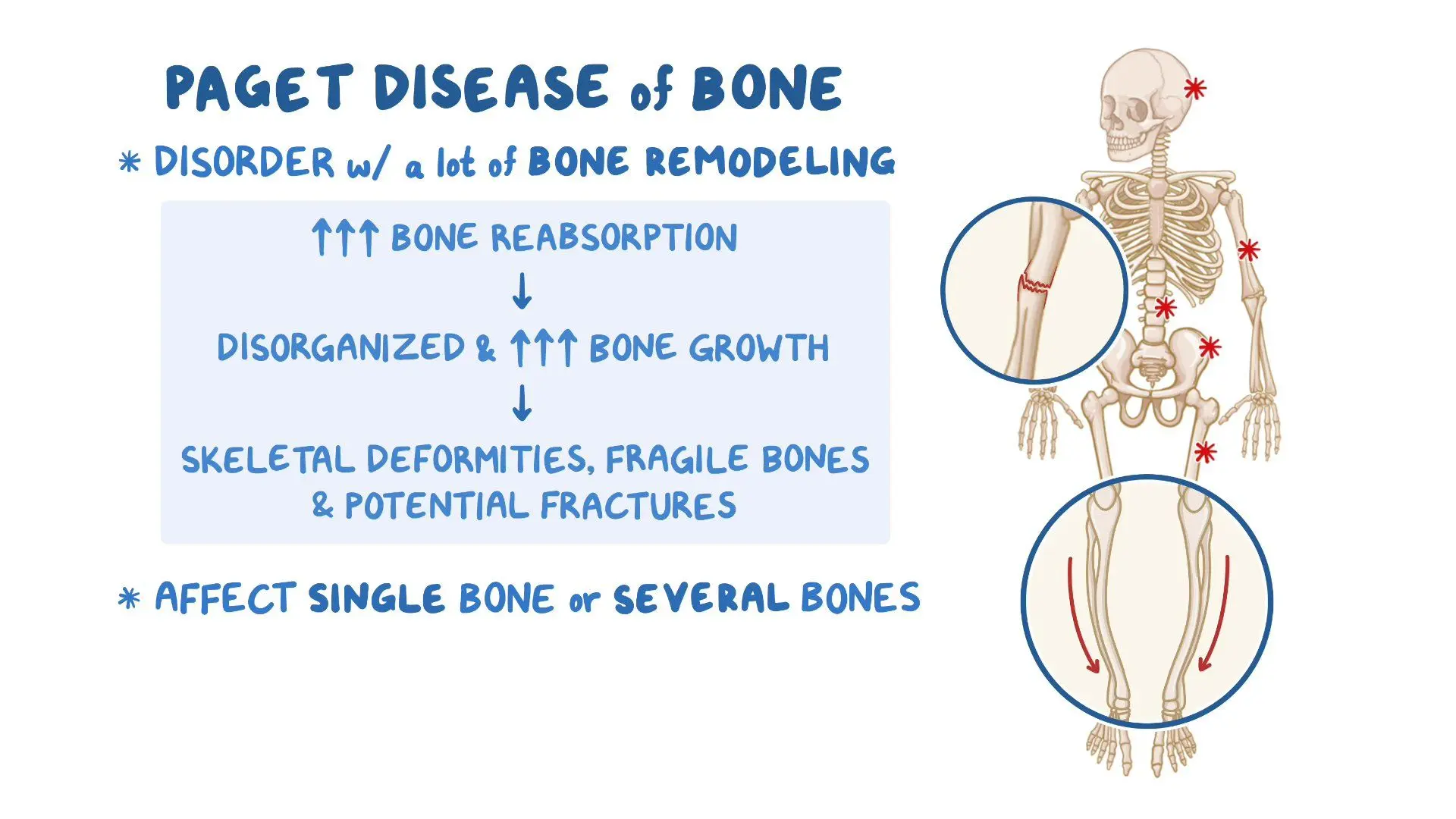 Paget s Disease Of Bone Sarasota Arthritis Center Paget s Disease Of Bone Sarasota Arthritis Center
